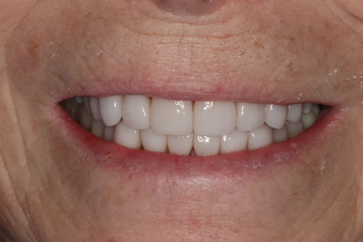 After: A.S.'s smile in 2026, thirteen years after treatment