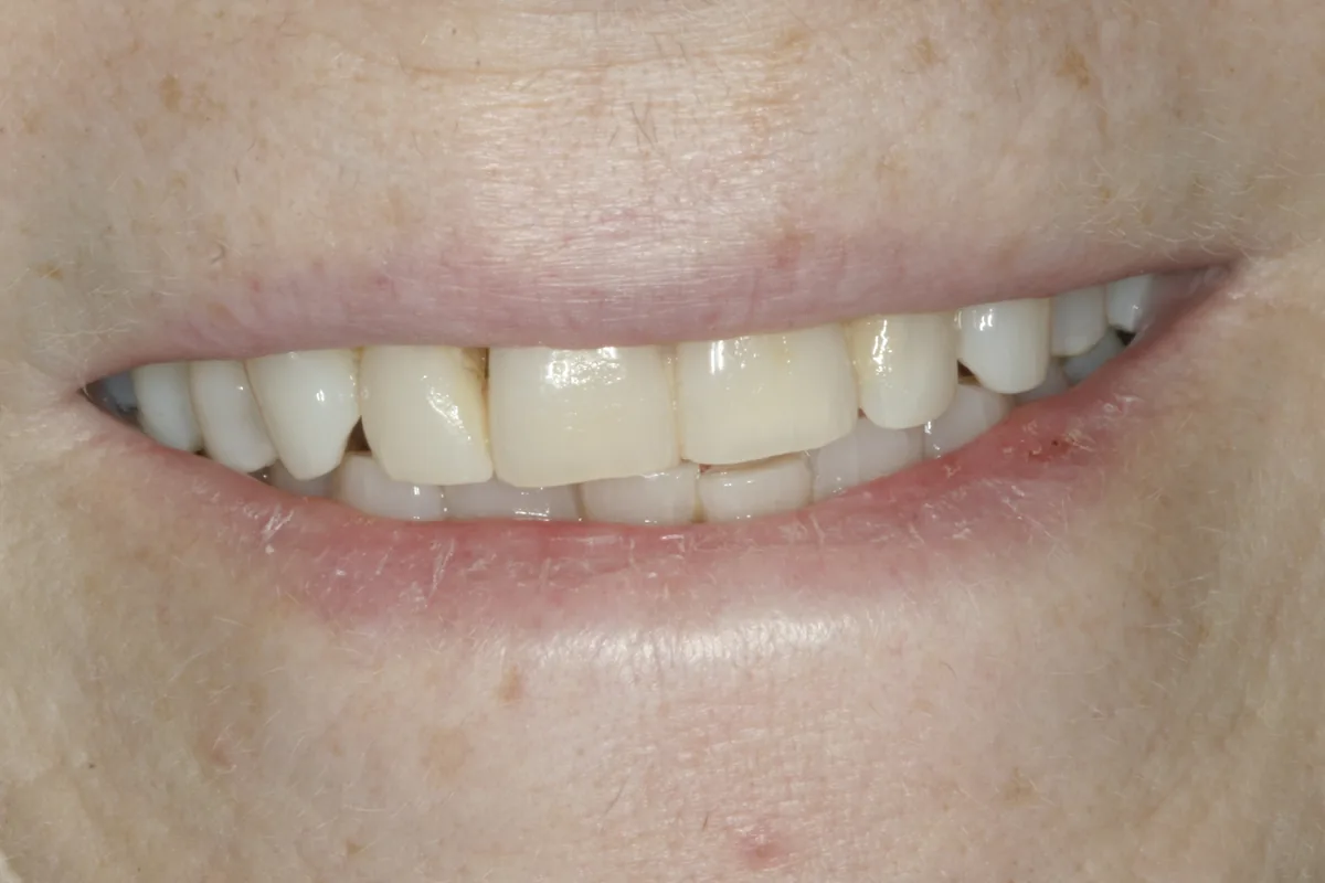 Before: A.S.'s smile in 2013
