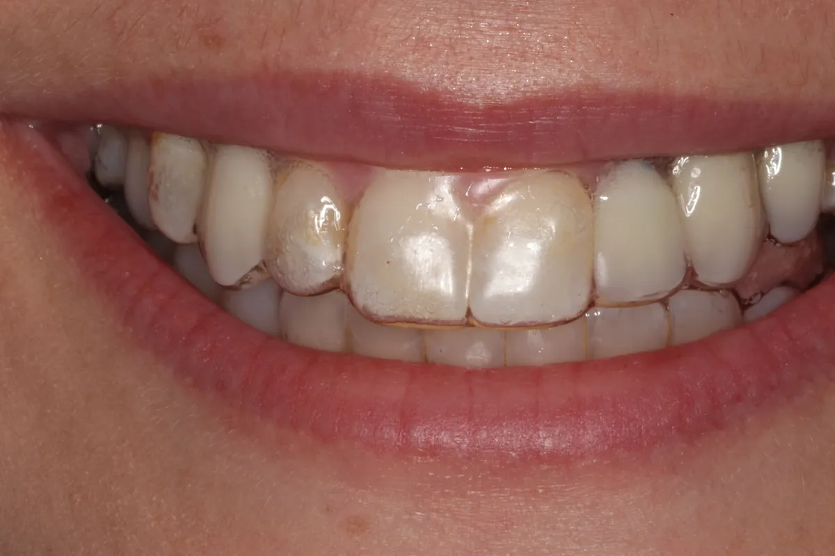 Before: B.R.'s smile