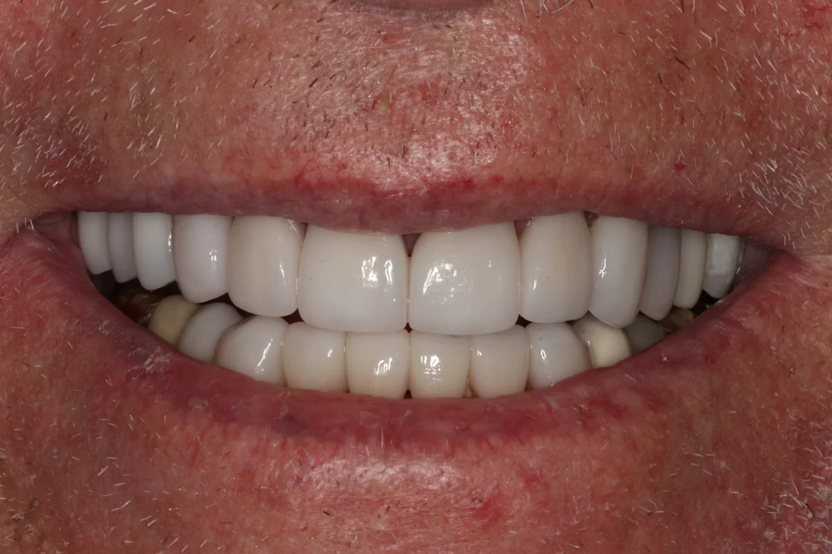 After: C.J.'s smile with all-ceramic crowns