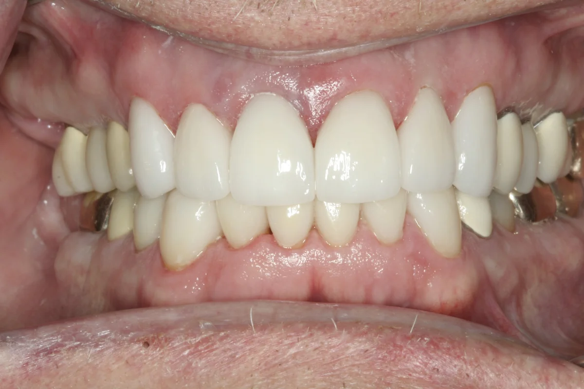 After: C.J.'s all-ceramic crowns, with no dark line at the gum
