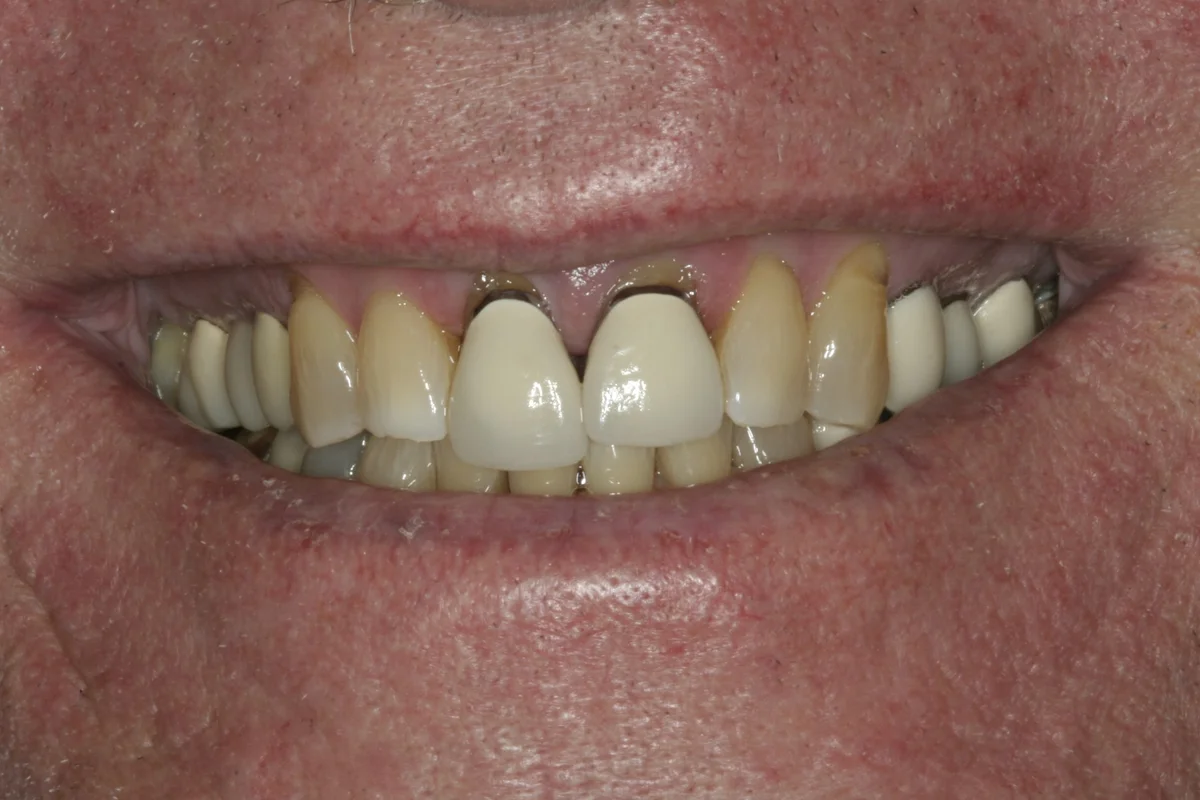 Before: C.J.'s smile, with the metal collars of two old front crowns showing as a dark band at the gum line