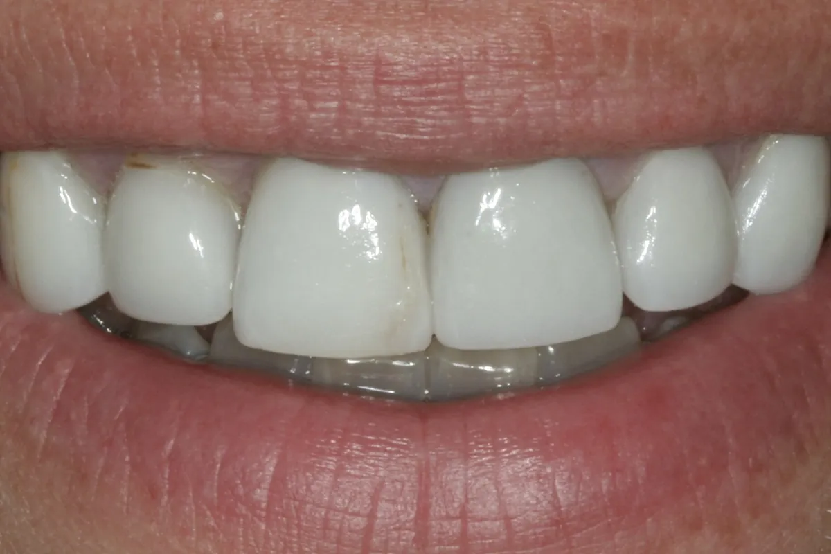 Before: C.S.'s smile