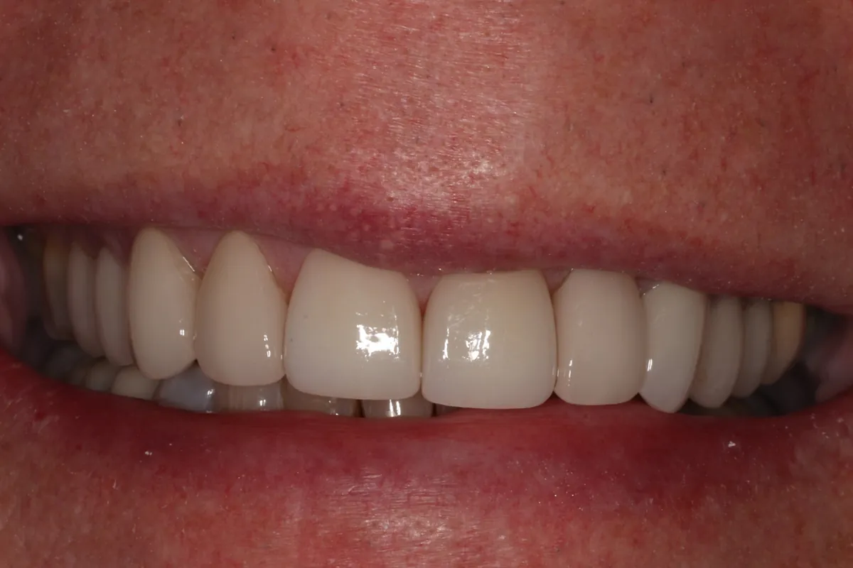 After: D.E.'s smile restored