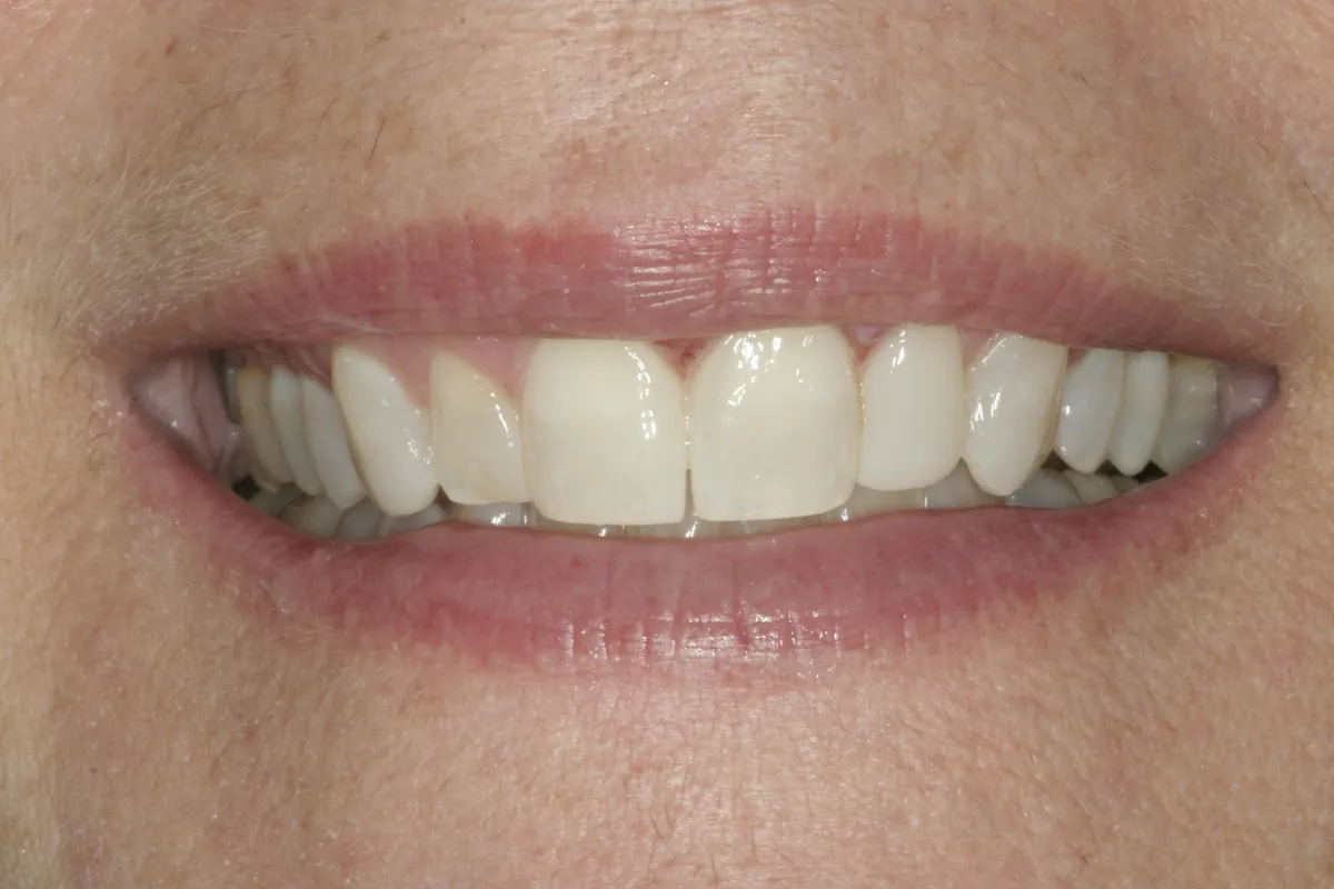 Before: D.P.'s smile