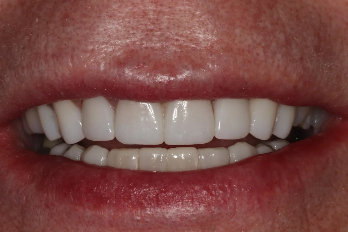 After: D.P.'s smile restored