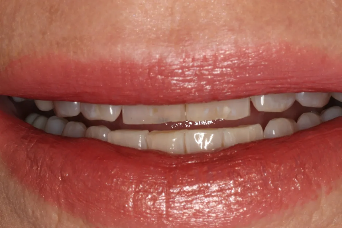 Before: D.T.'s smile
