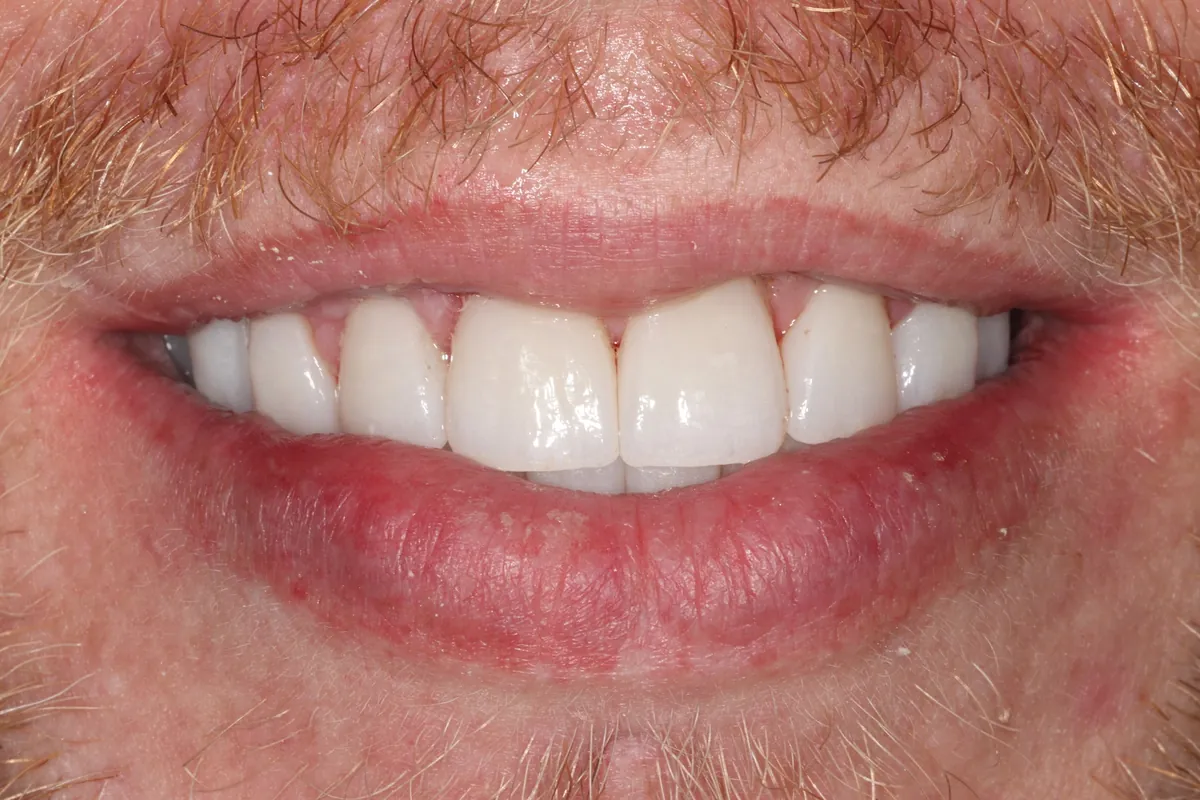 After: Derek's smile restored