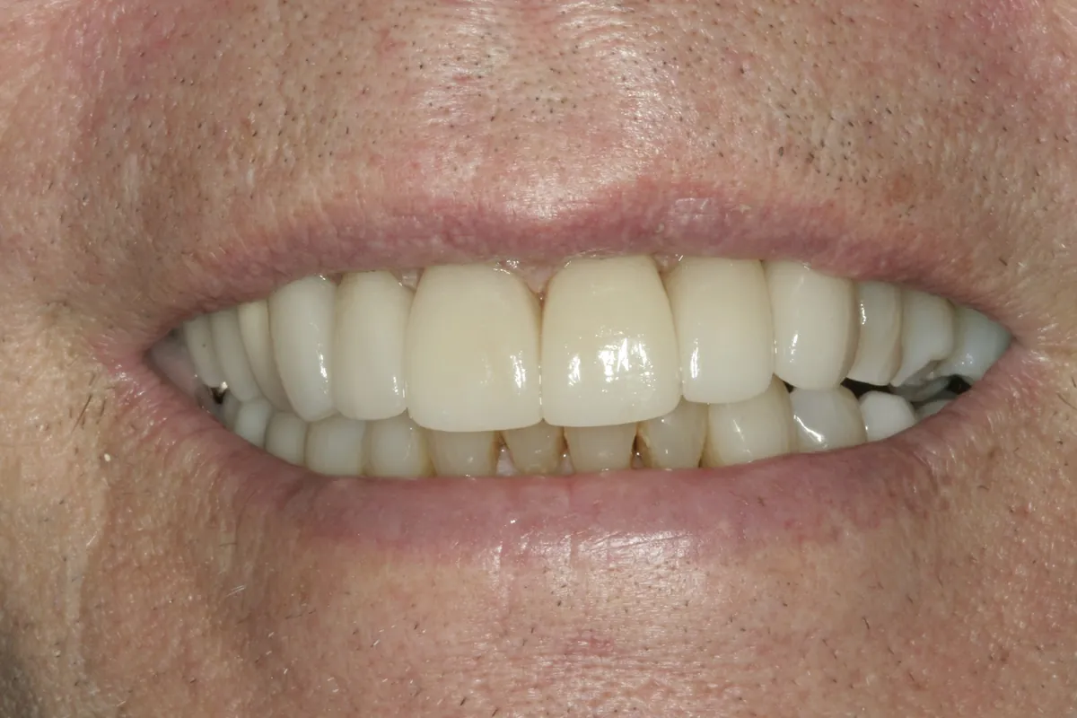 After: E.B.'s smile restored