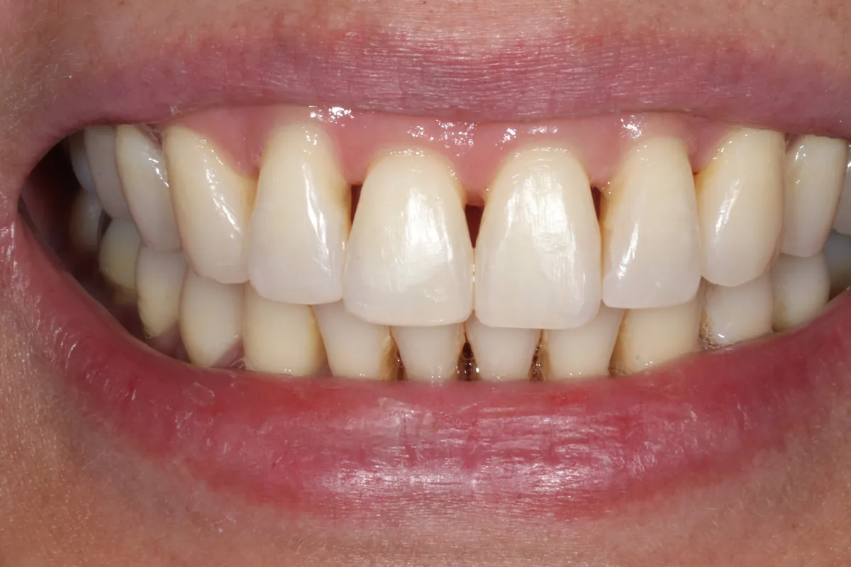 Before: E.C.'s smile