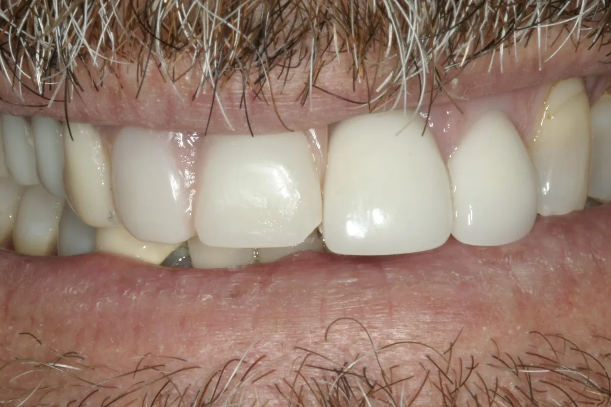 Before: G.B.'s smile