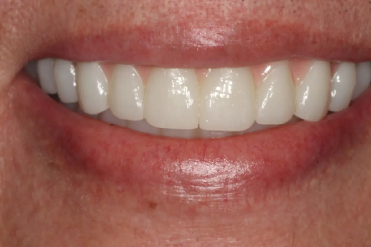 After: J.D.'s smile restored