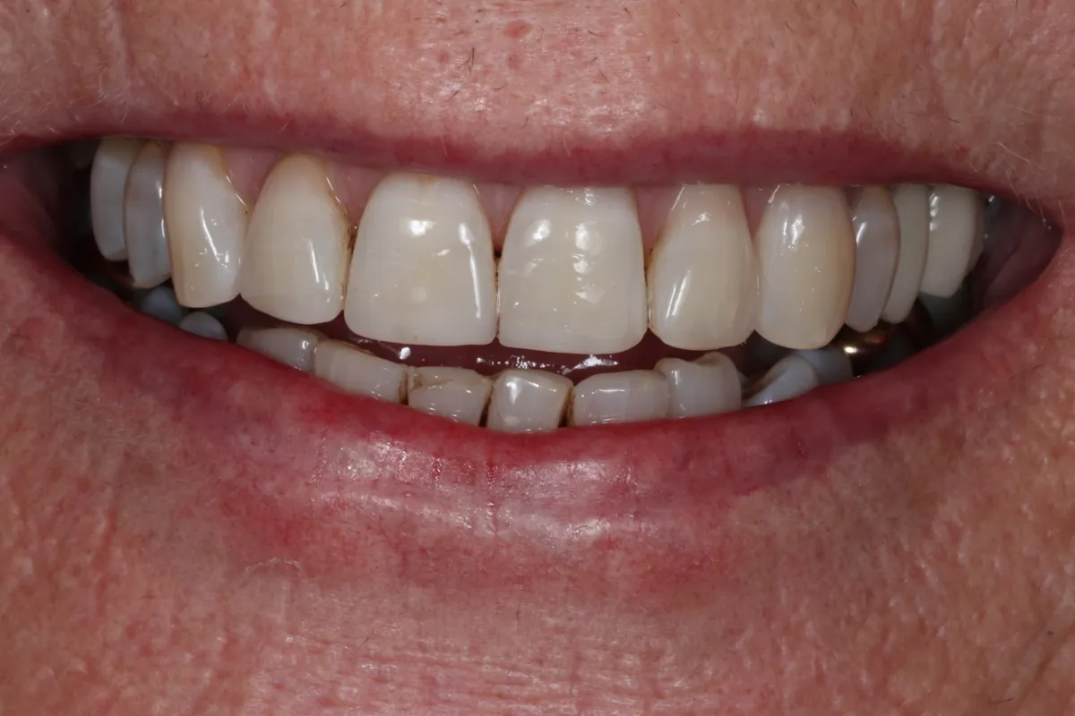 After: K.G.'s smile restored