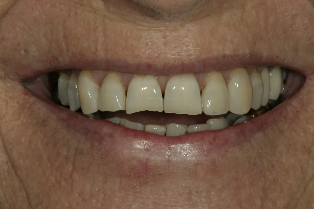 Before: K.G.'s smile
