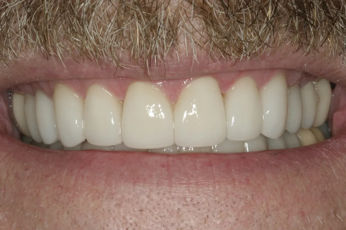 After: K.S.'s smile restored
