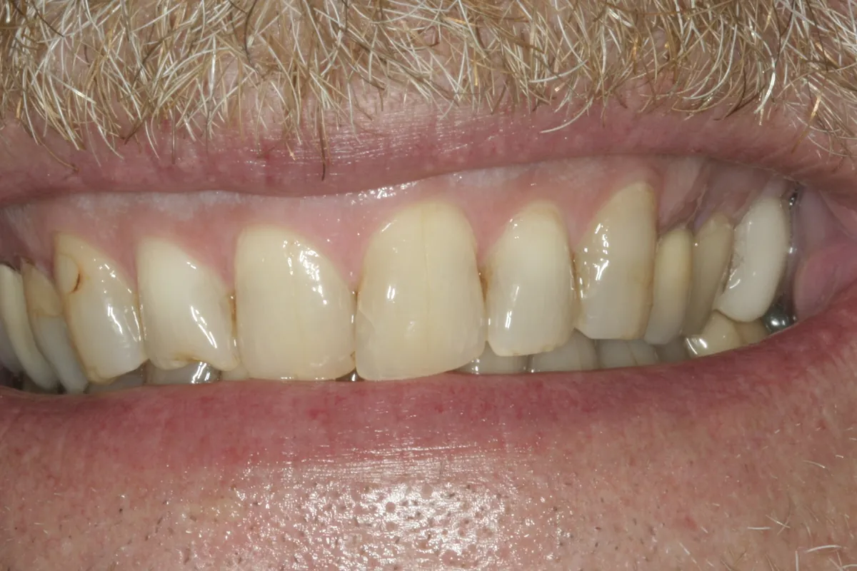 Before: K.S.'s smile
