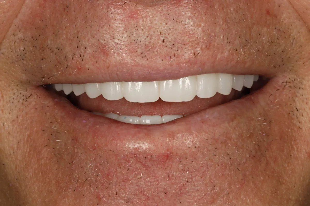 After: Kurt's smile restored