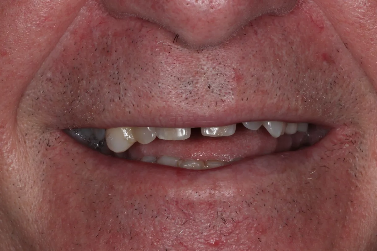 Before: Kurt's smile