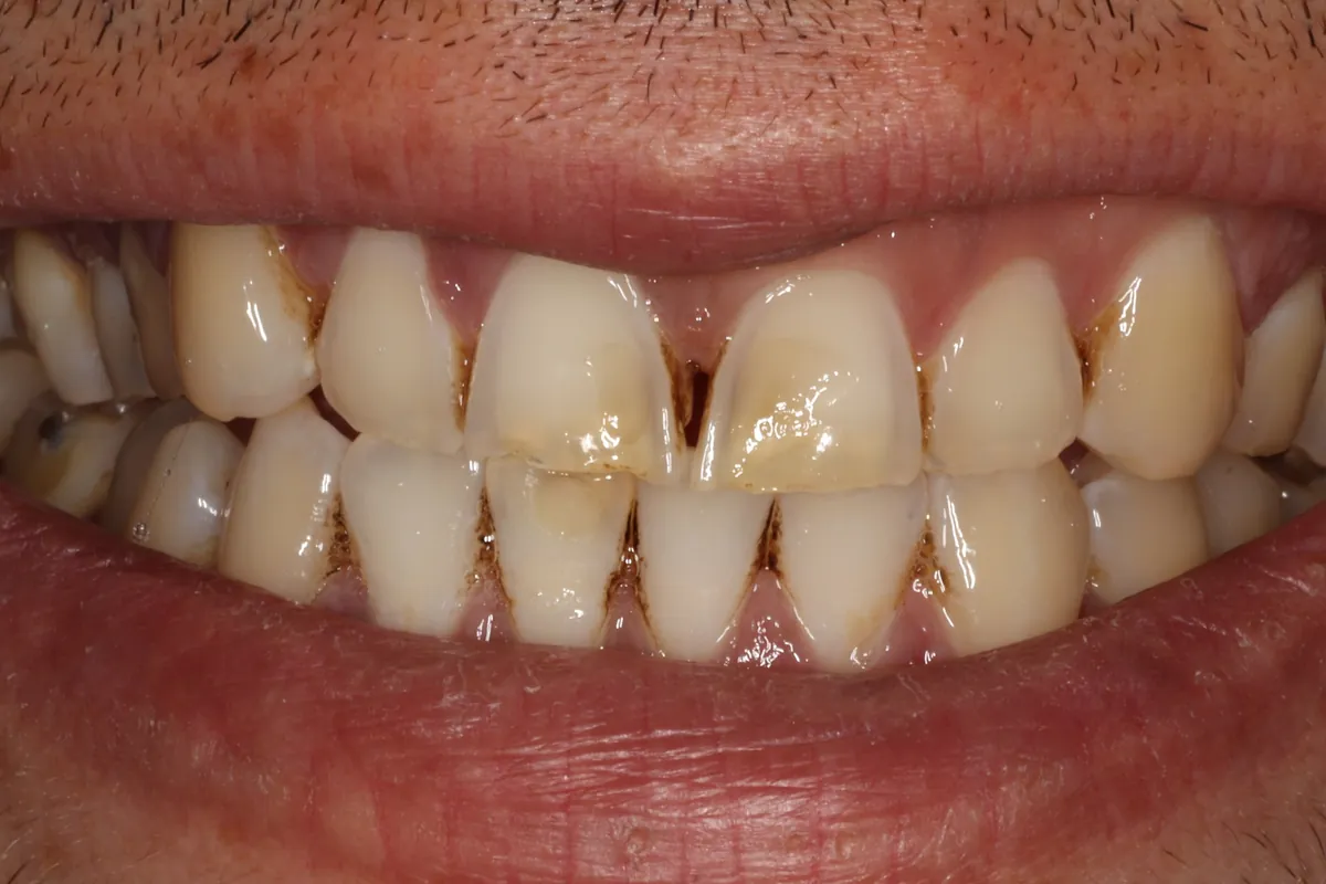 Before: L.B.'s smile