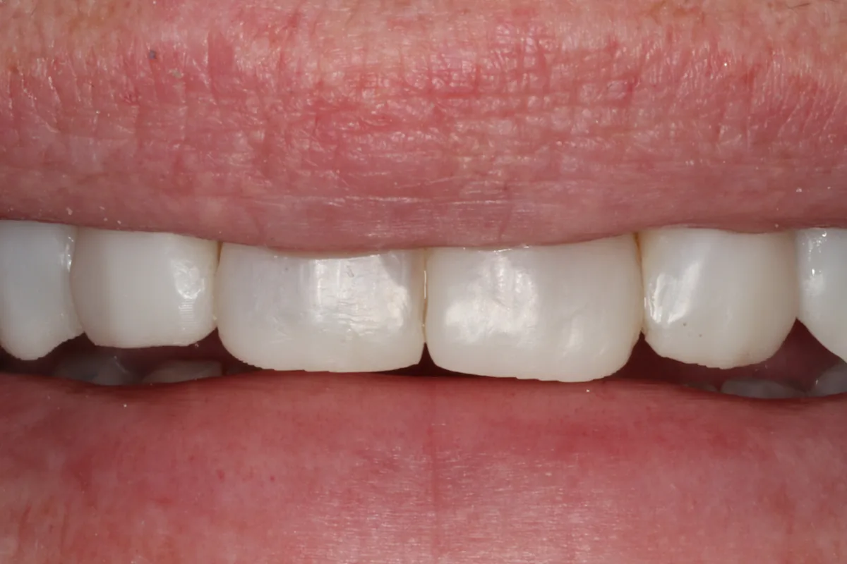 After composite veneers: the upper front teeth rebuilt to an even shape, length and color.