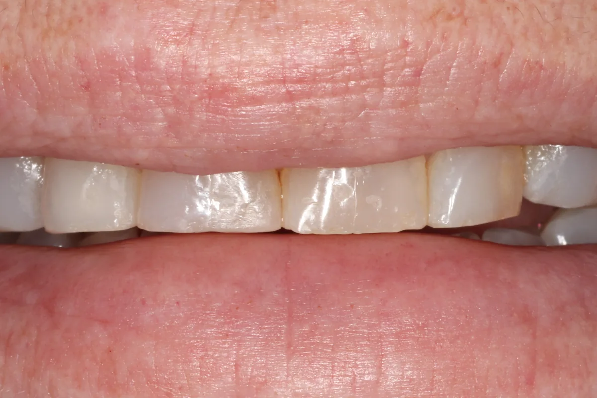 Before composite veneers: upper front teeth worn, uneven and discolored.
