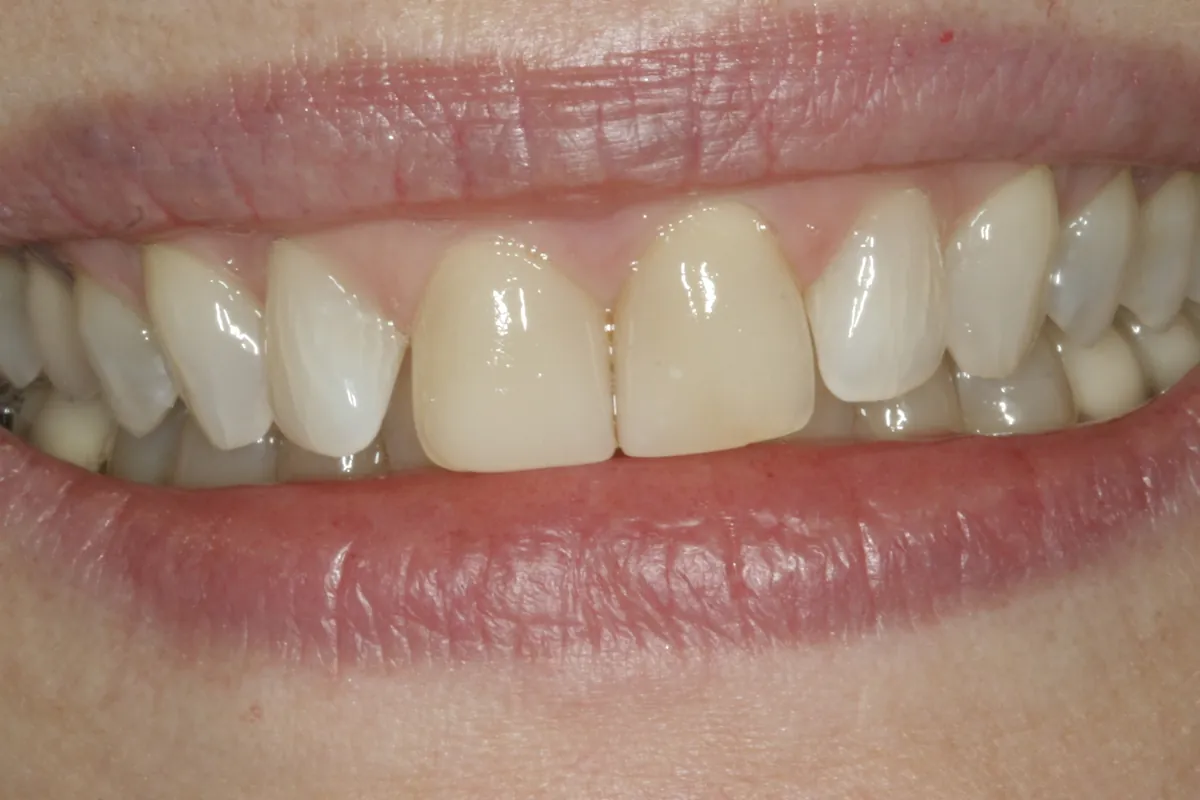 Before: L.G.'s smile