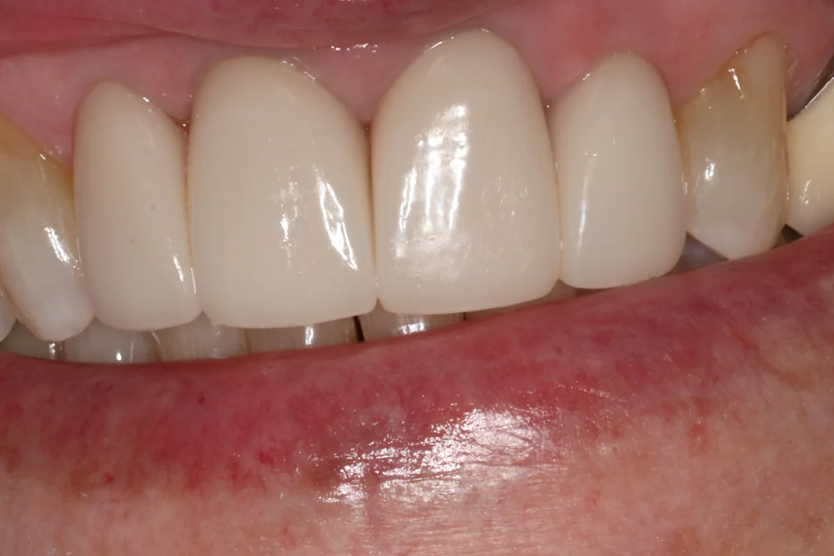 After: M.J.'s upper front teeth with new all-ceramic crowns and no dark line at the gum