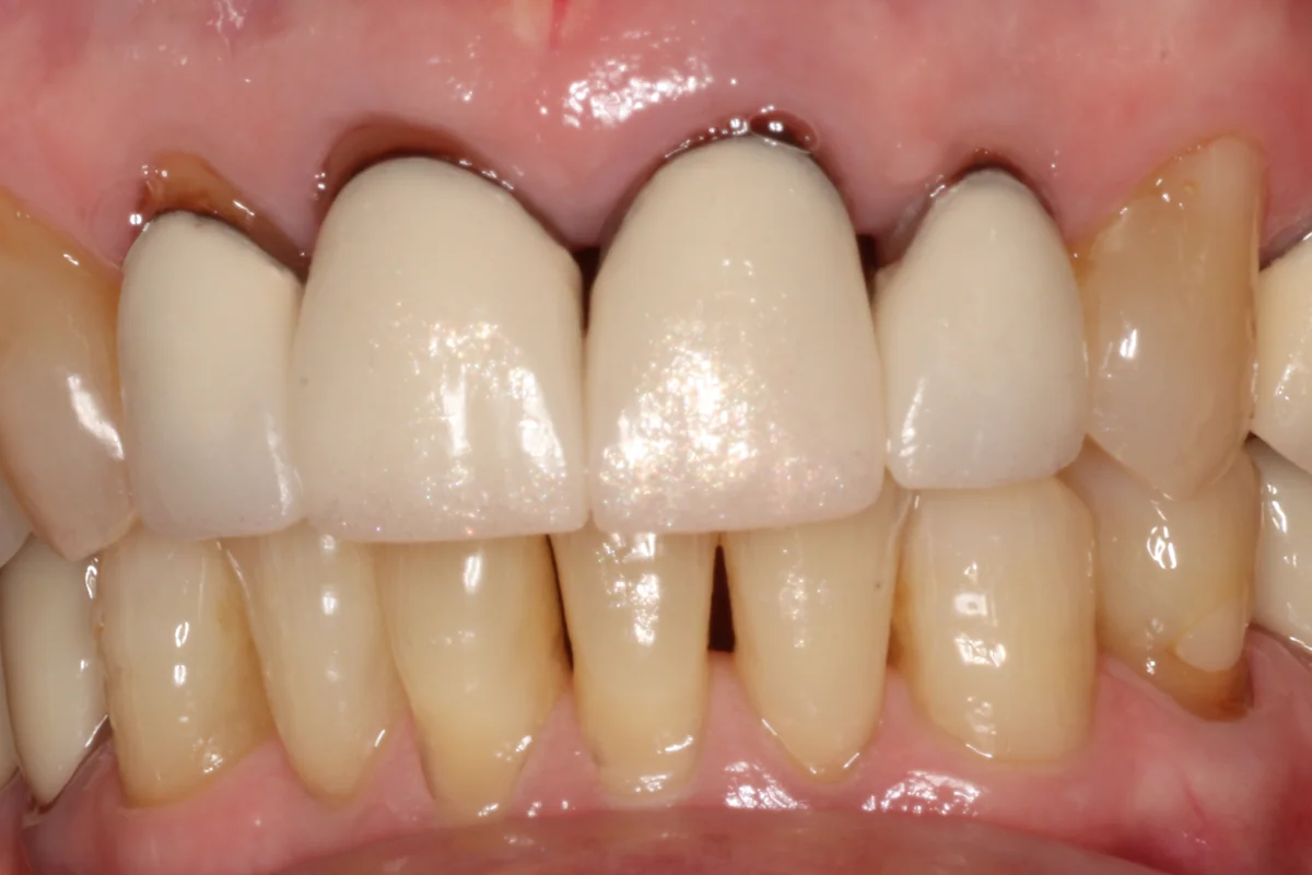 Before: M.J.'s old upper front crowns with dark lines at the gum line