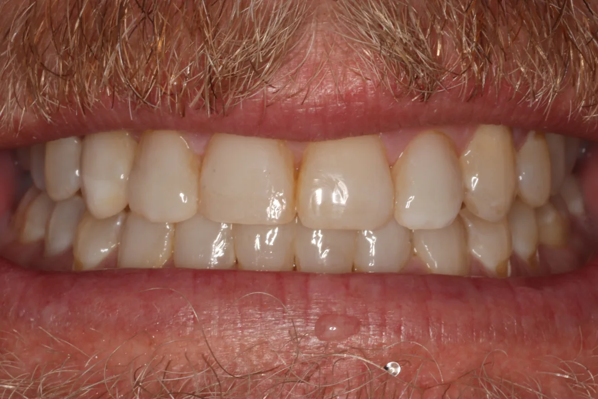 After orthodontics and bonding: the upper front six teeth aligned, with even, rebuilt edges.