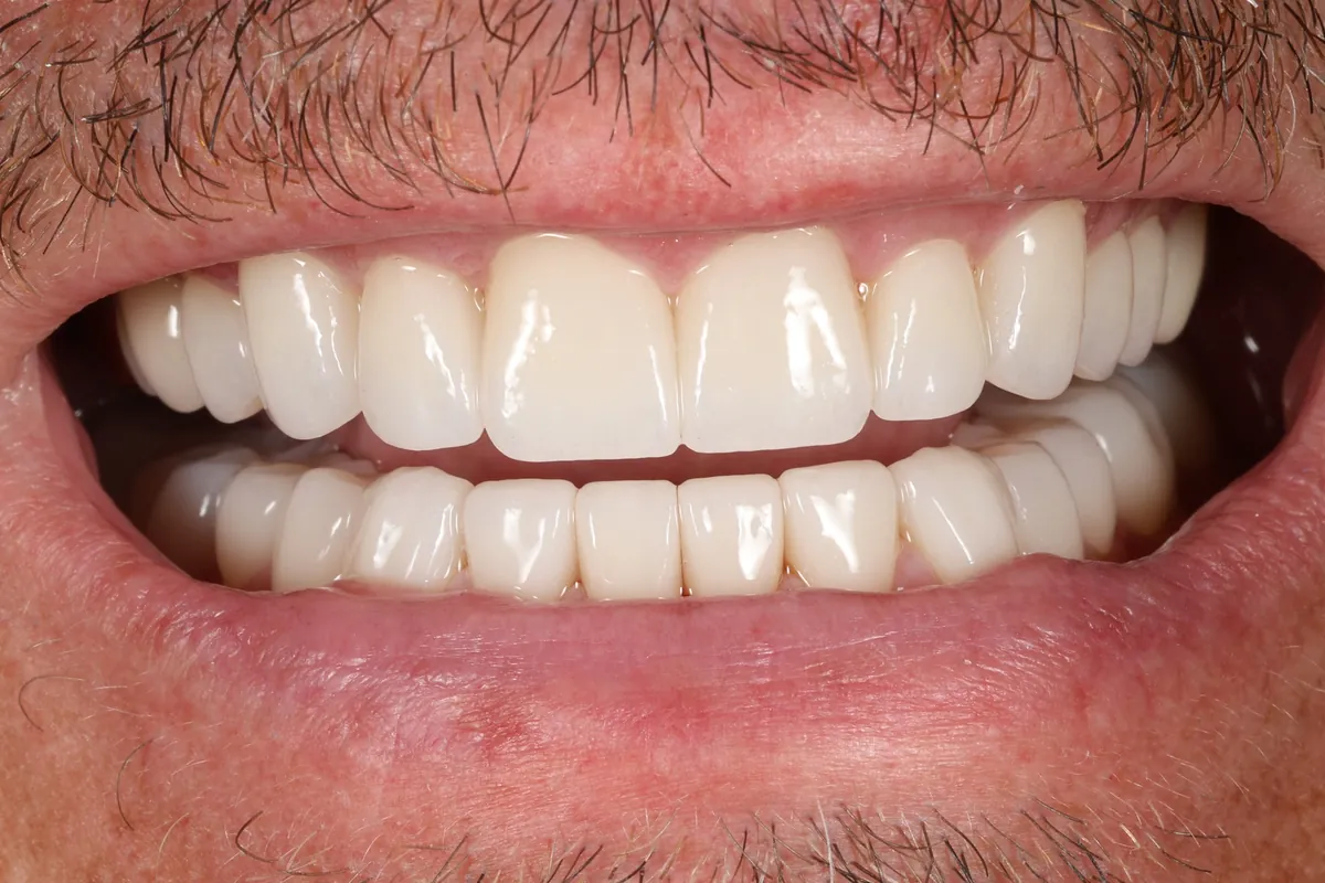 After: P.B.'s smile restored