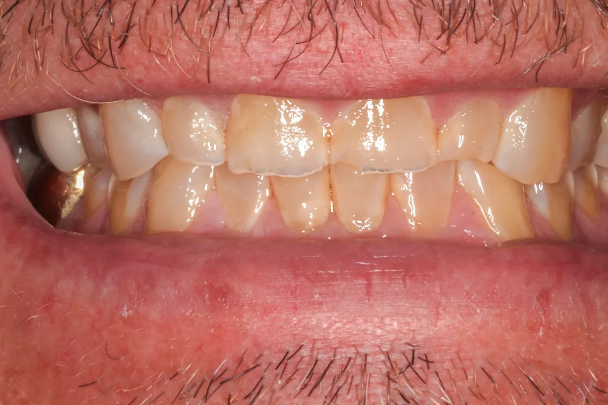 Before: P.B.'s smile
