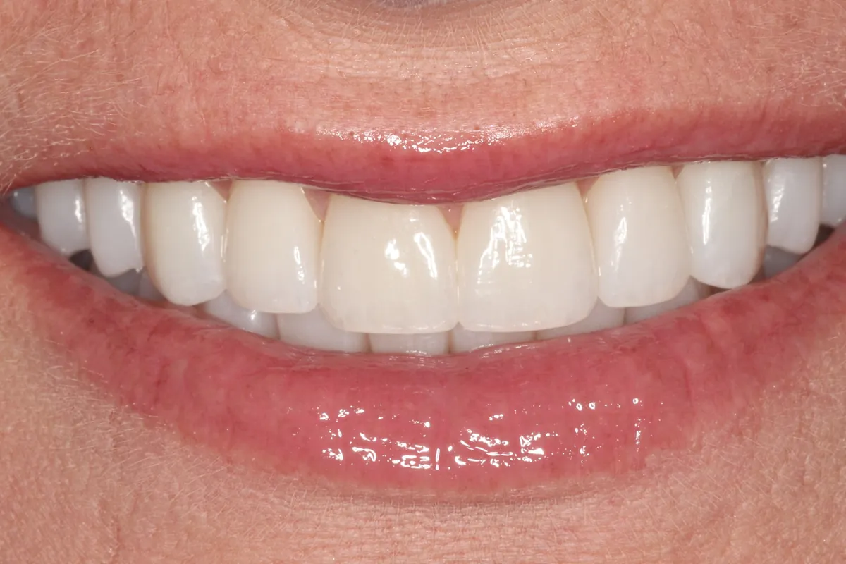 After: P.M.'s smile restored