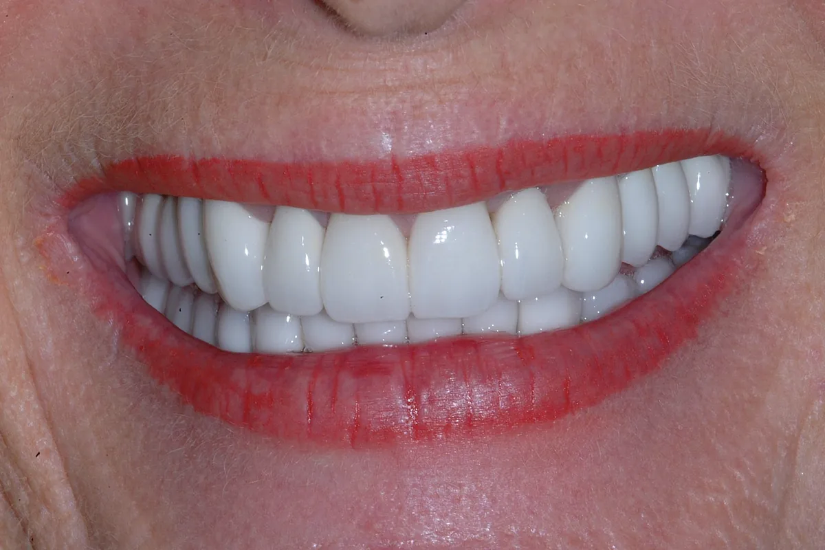 After: P.P.'s smile restored
