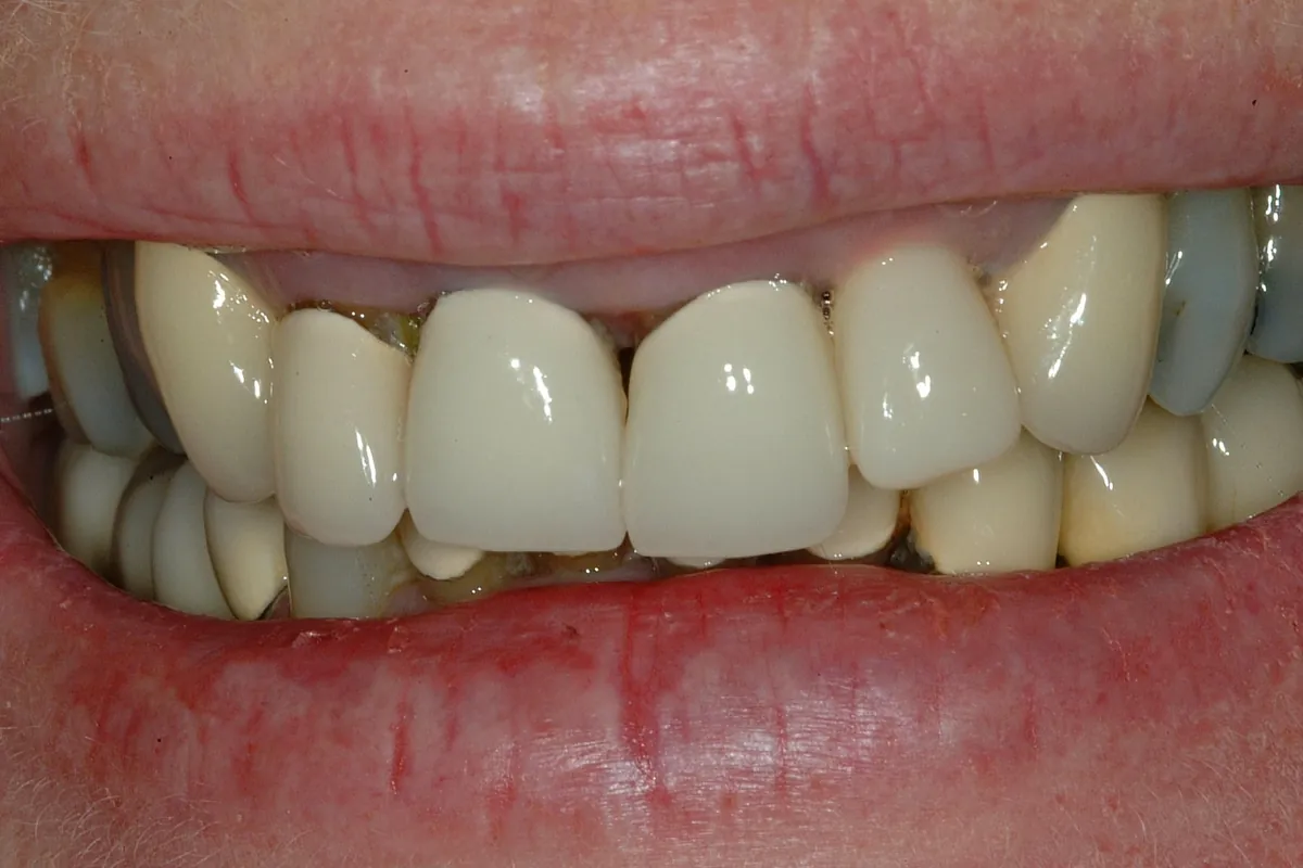 Before: P.P.'s smile