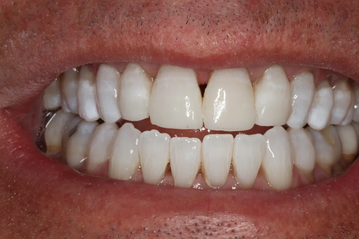After new bonding: the two upper front teeth now match the whitened teeth beside them.