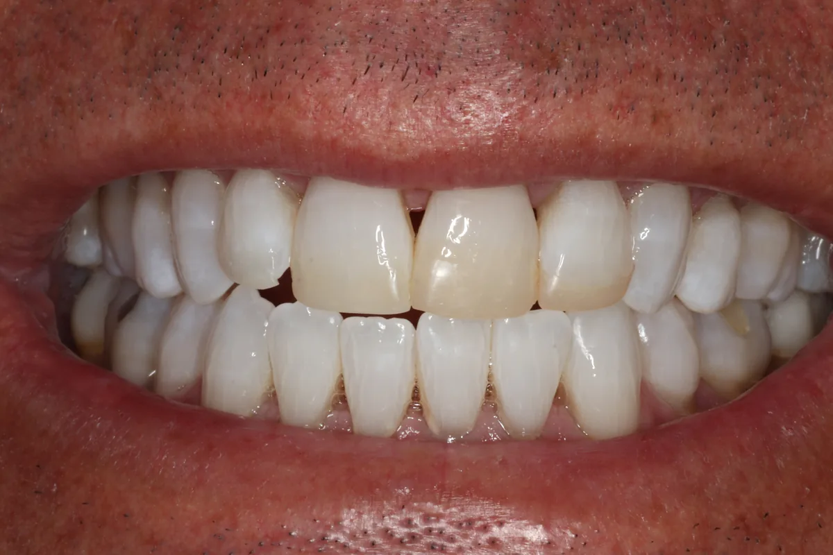 After whitening, before new bonding: the old bonding on the two upper front teeth looks yellow next to the whitened teeth around it.