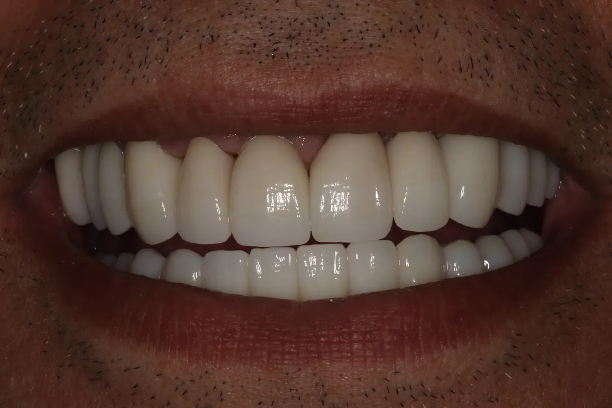 After: S.V.'s smile restored