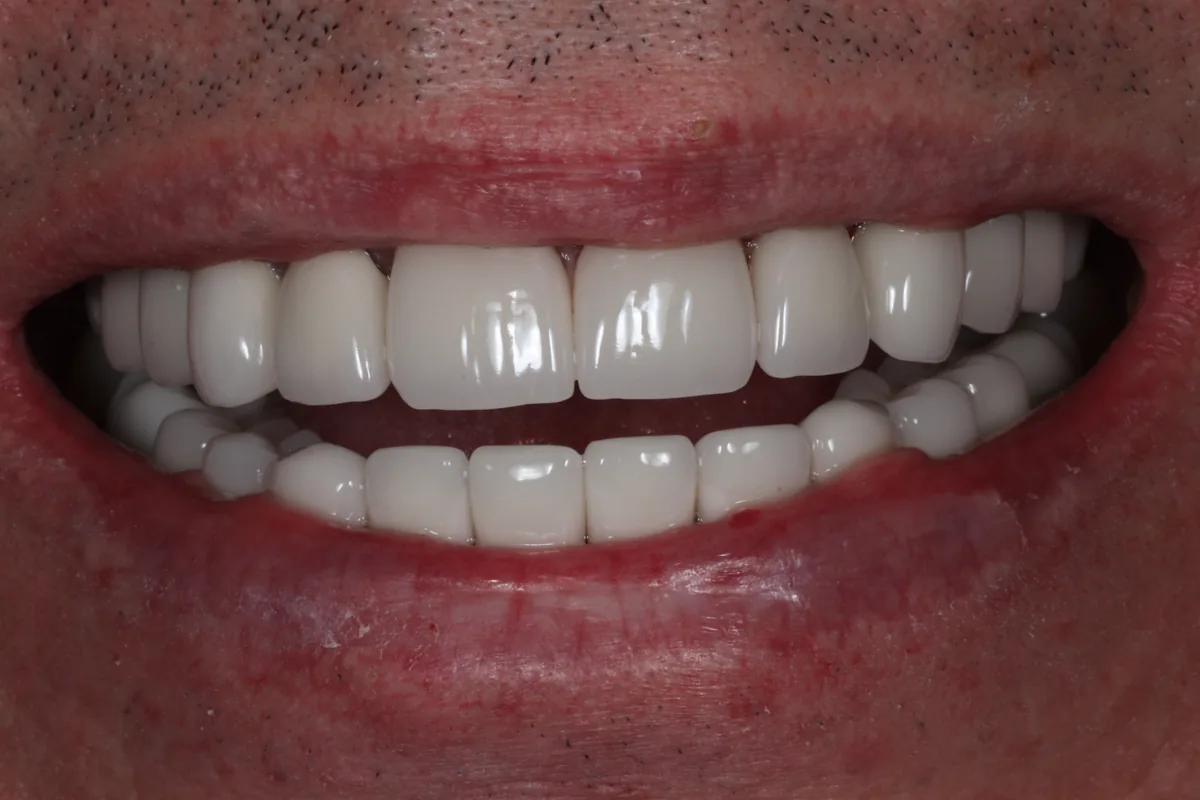 After: T.C.'s smile in 2023, twenty years after treatment