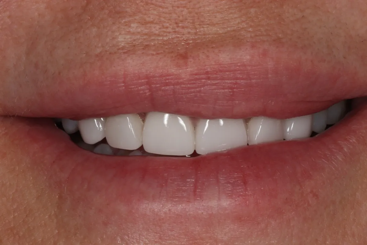 Before: T.F.'s smile