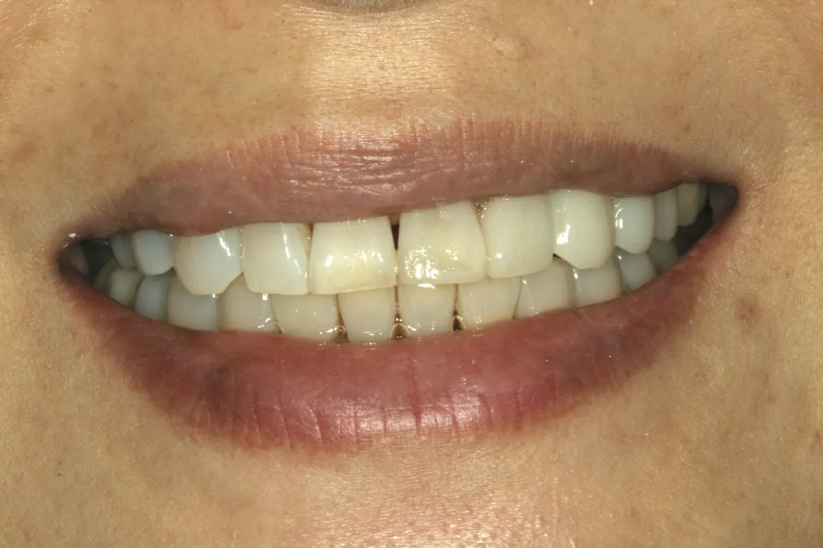 After: Y.M.'s smile restored