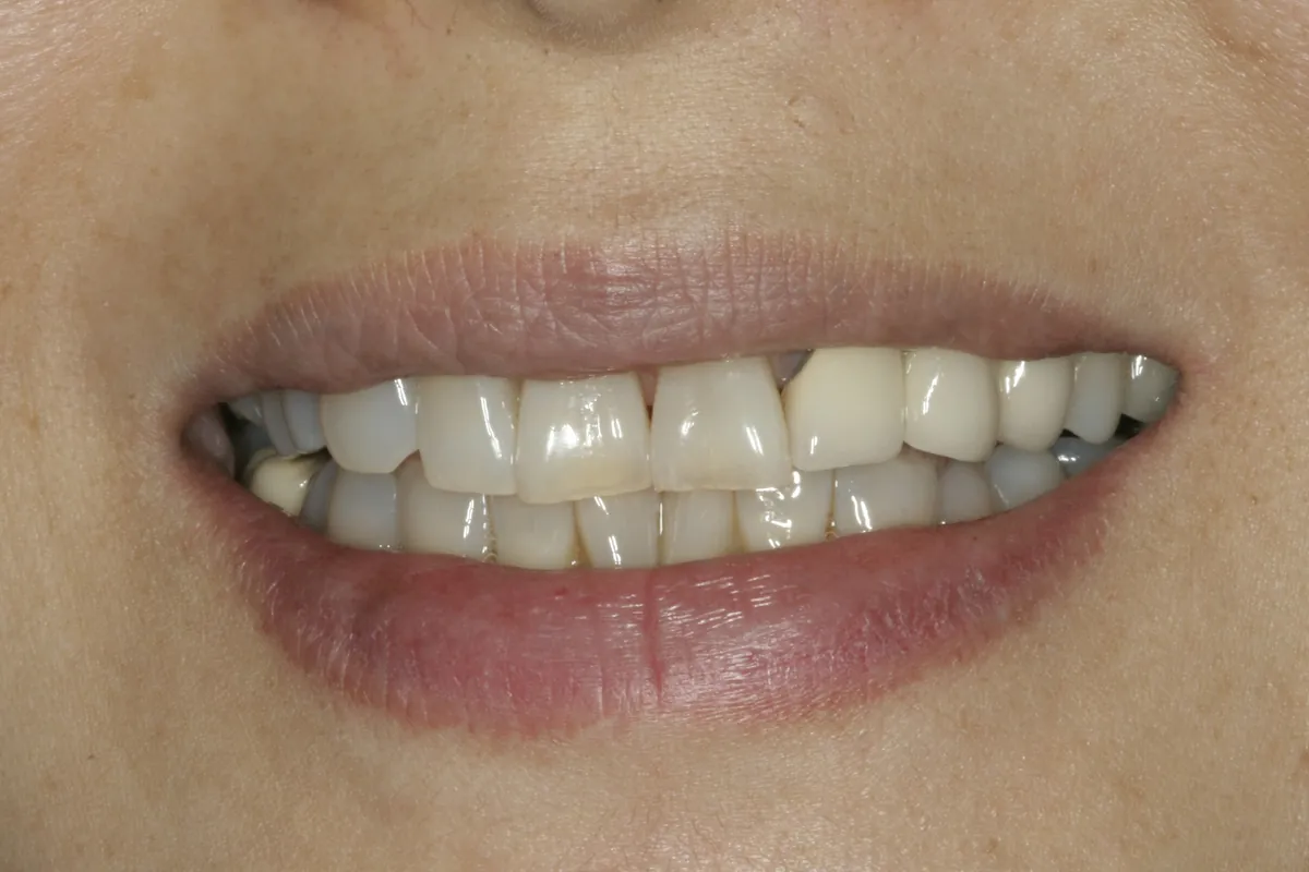Before: Y.M.'s smile