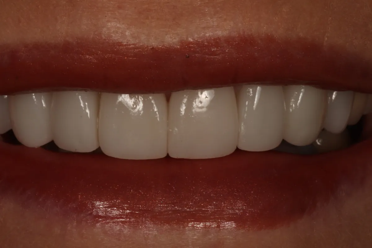 After: C.L.'s smile restored