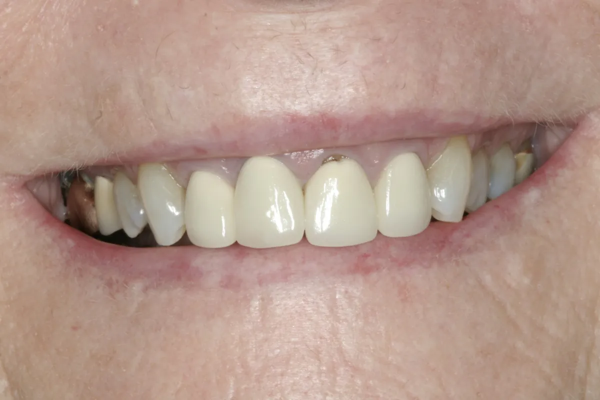 Before: J.B.'s smile