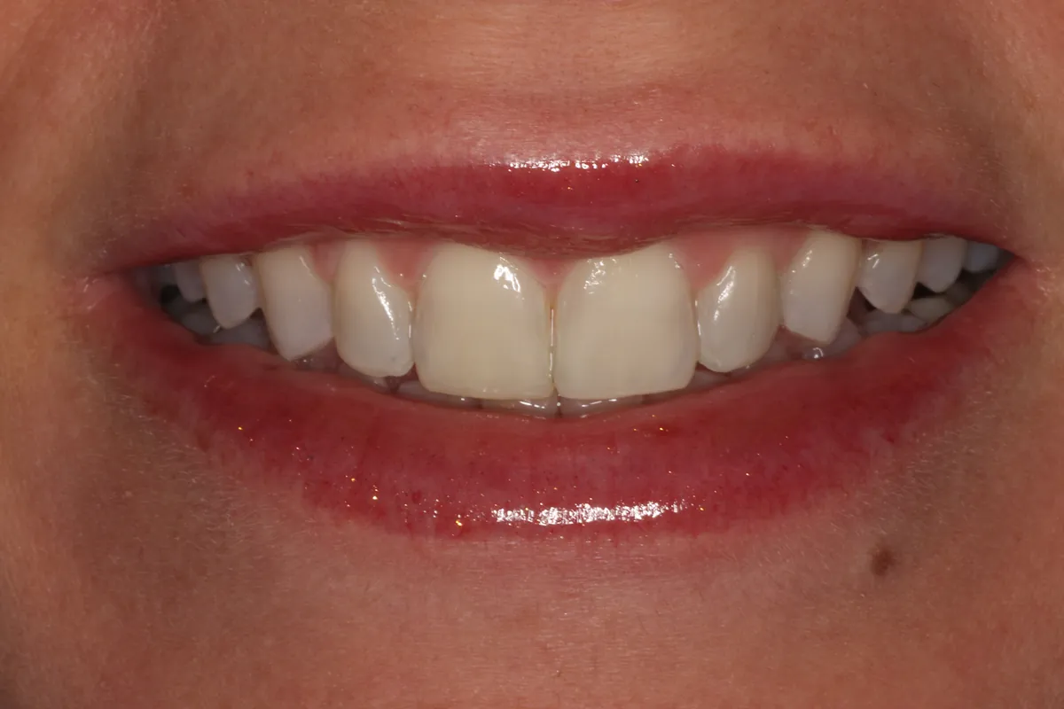 After: J.C.'s smile straightened and reshaped
