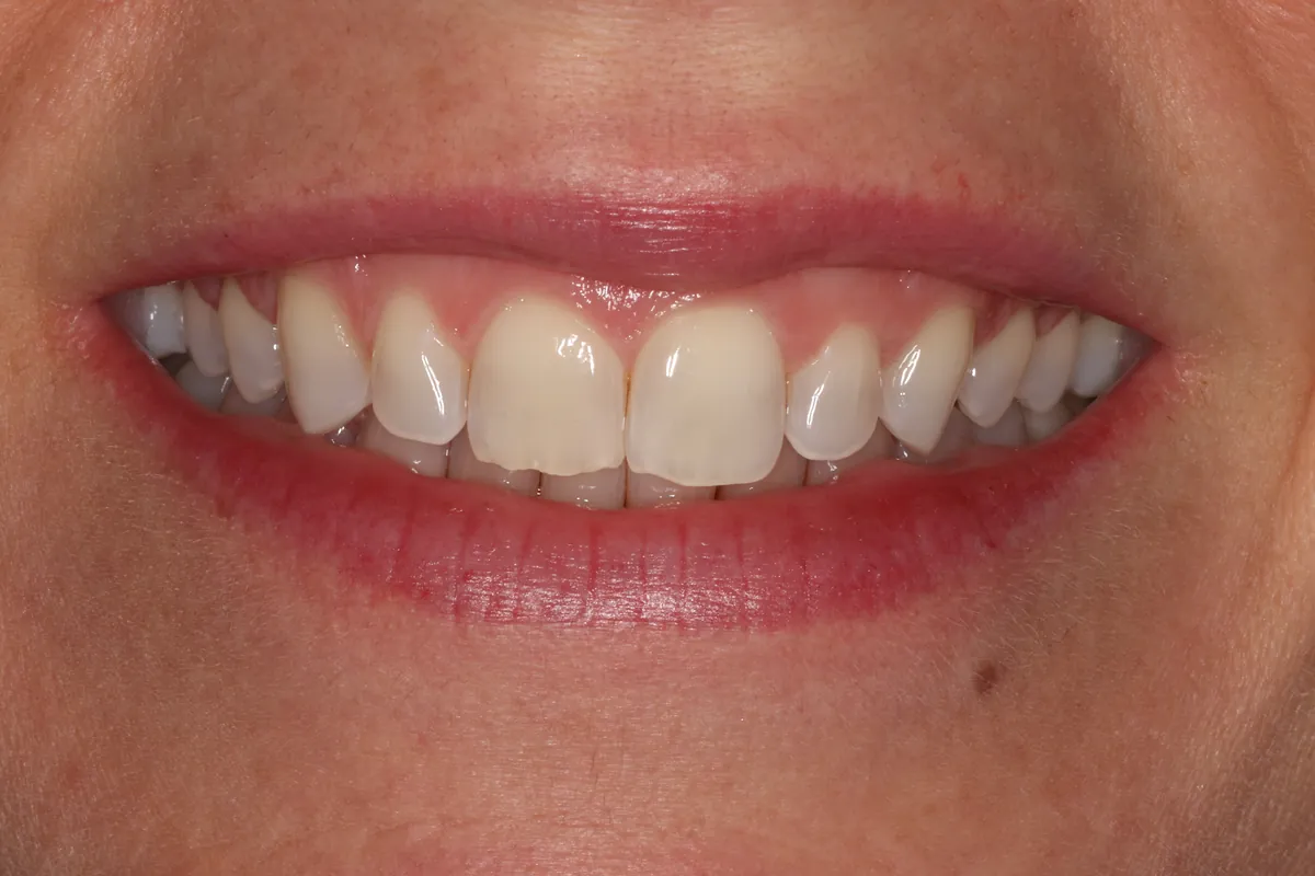 Before: J.C.'s smile