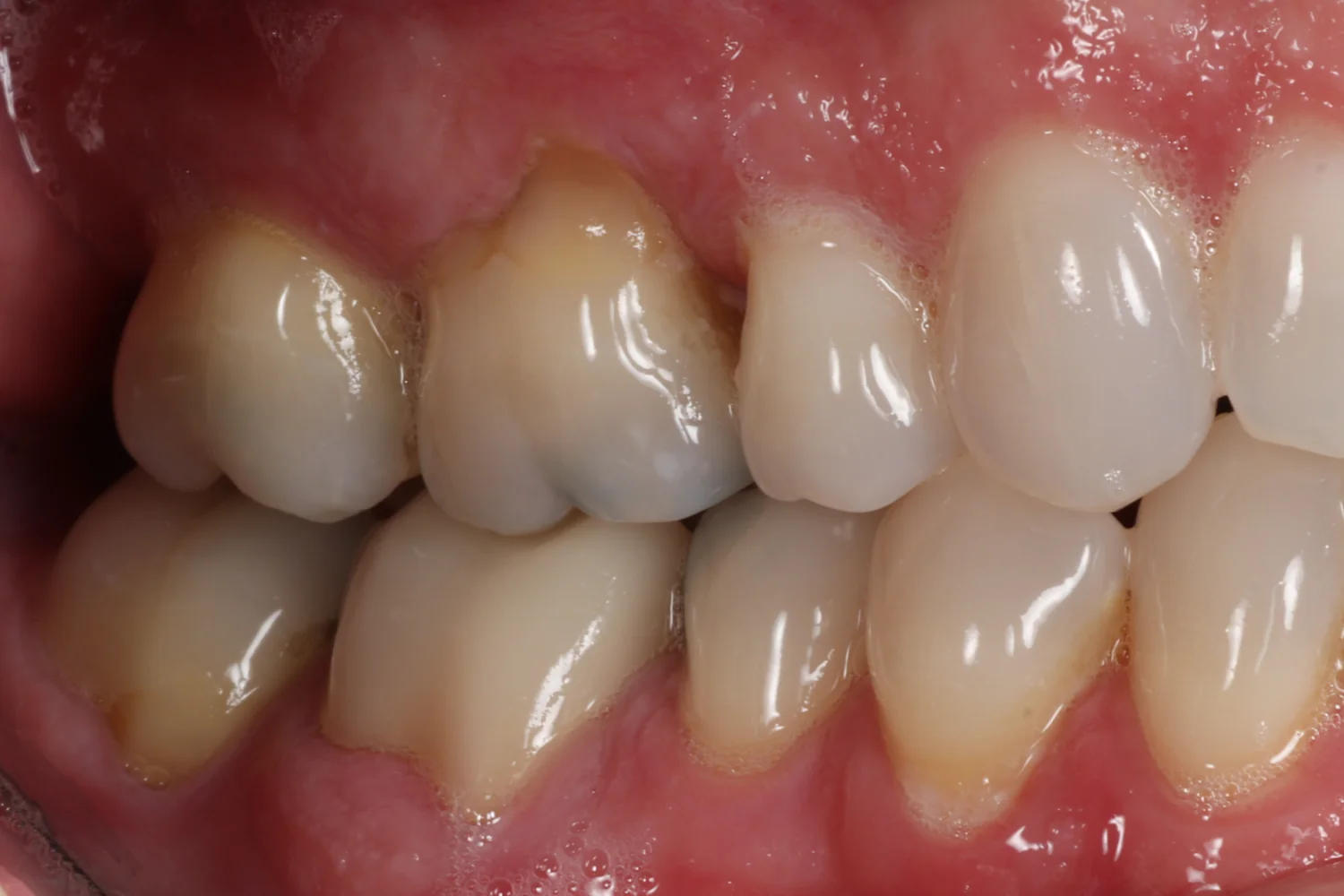 Side view of upper and lower back teeth. The upper first molar has a notch worn into it at the gum line, and the teeth beside it do not.