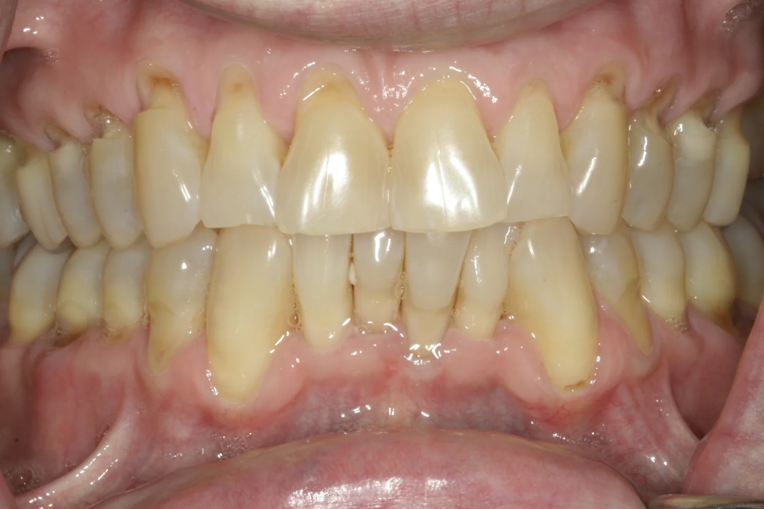 Front view of upper and lower teeth. Several upper teeth on both the left and right sides have notches worn into them at the gum line.
