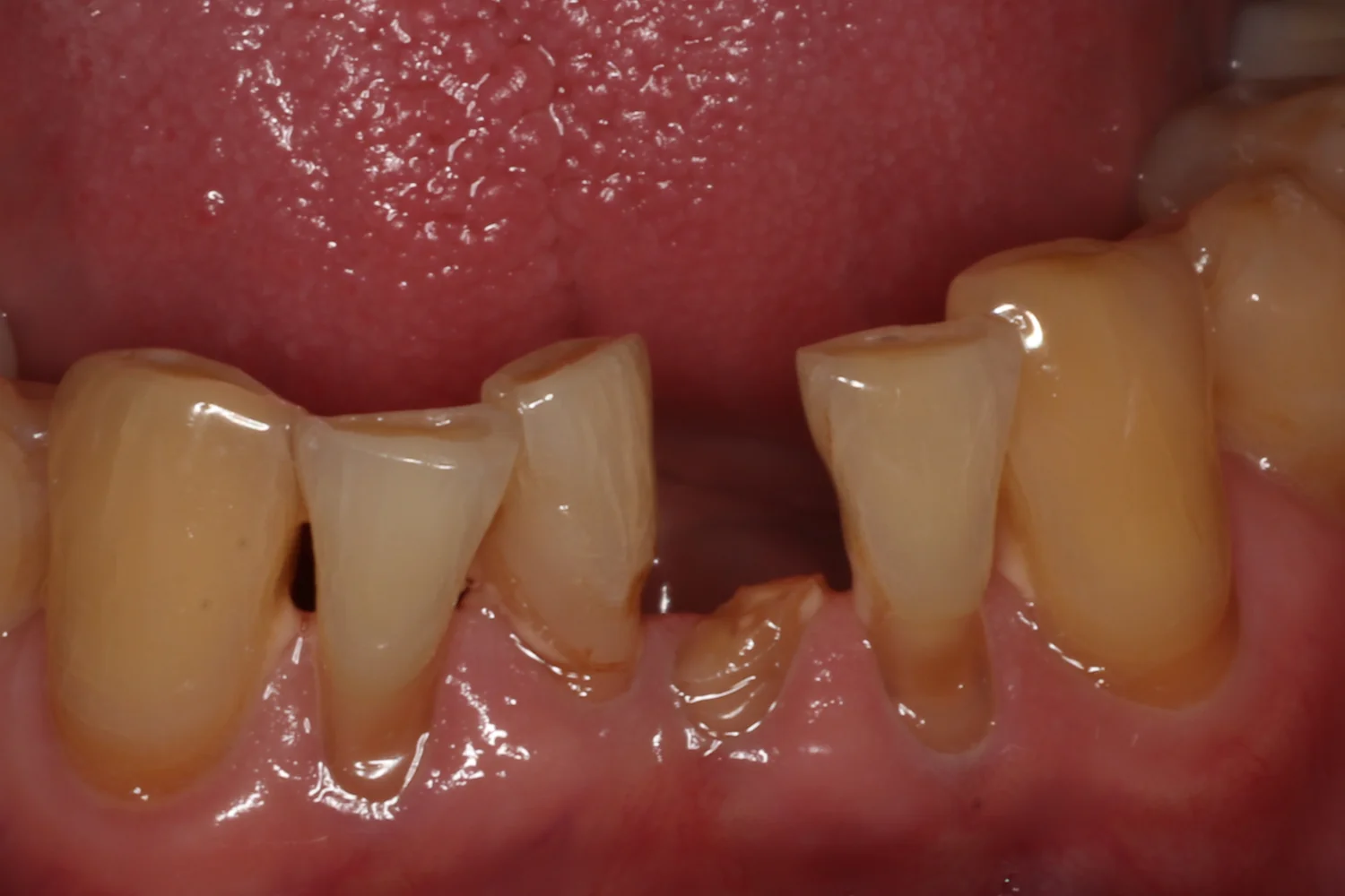 Lower front teeth with one tooth broken off at the gum line.