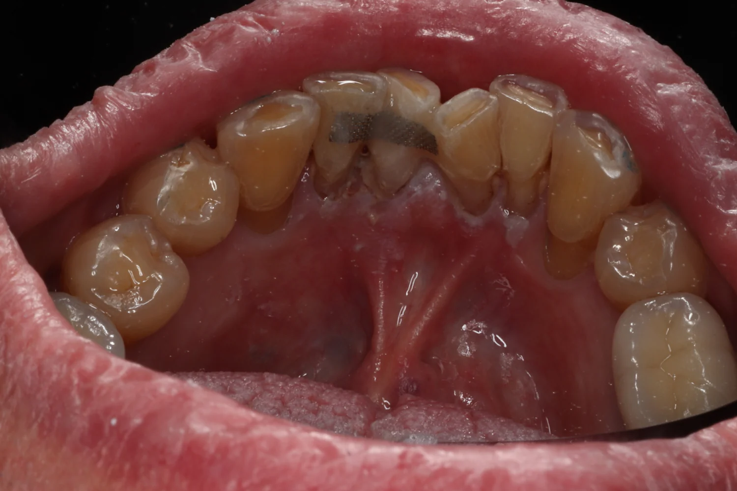 The lower front teeth seen from the tongue side, with the broken tooth bonded back into place.