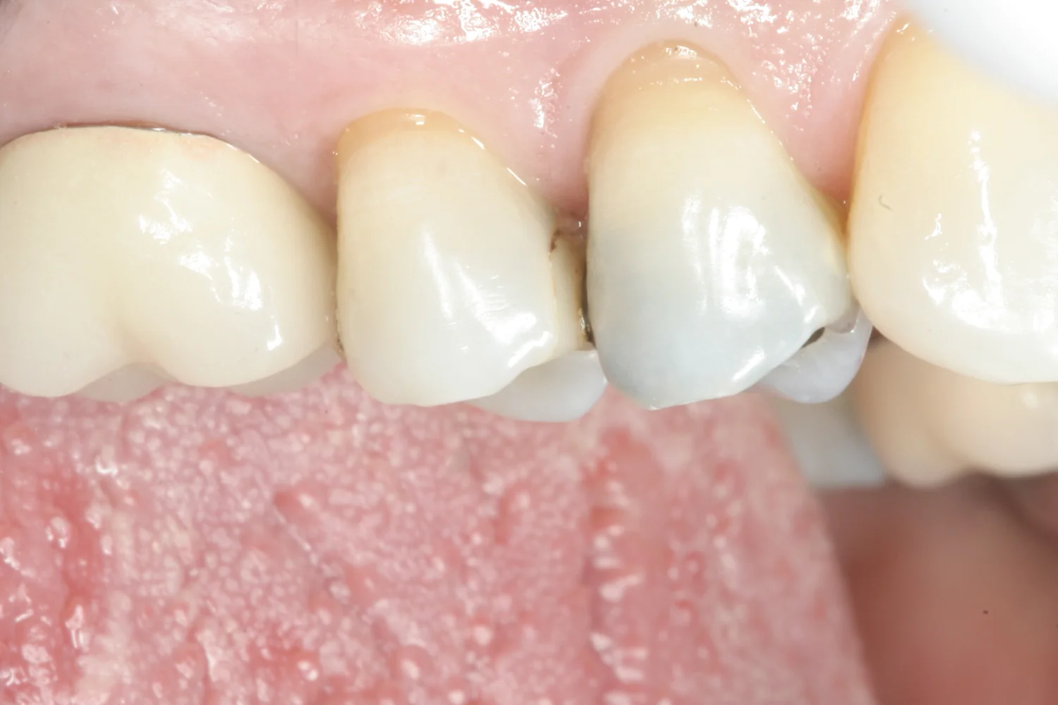 Upper back teeth seen from the side, with a tooth-colored filling that has failed and is leaking at its edge.